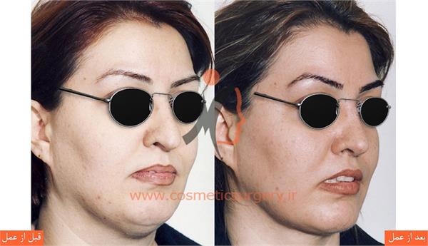 جراحی زیبایی بینی