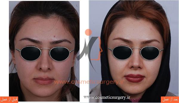 ترمیم بینی در بیماری که قبلا توسط جراحان دیگری عمل شده است