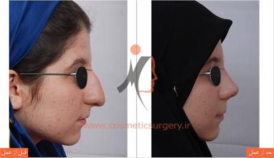 جراحی زیبایی بینی