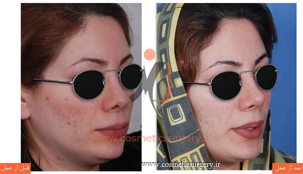 ترمیم بینی در بیماری که قبلا توسط جراحان دیگری عمل شده است