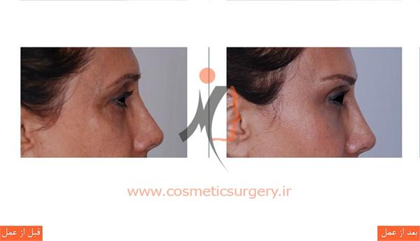 لیفت ابرو به همراه تزریق چربی