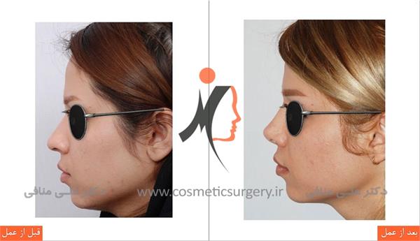 thick skinned rhinoplasty 1