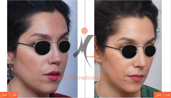 ترمیم بینی عمل شده توسط جراحان دیگر ( عمل بینی ثانویه )