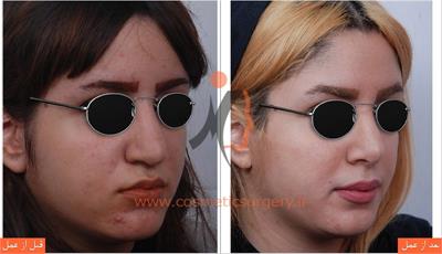 جراحی زیبایی بینی