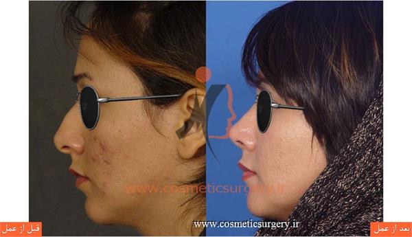 جراحی زیبایی بینی