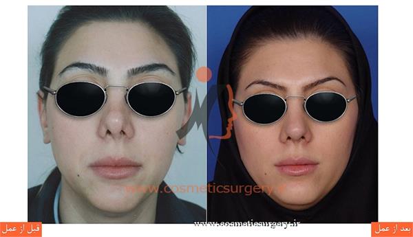 ترمیم بینی در بیماری که قبلا توسط جراحان دیگری عمل شده است