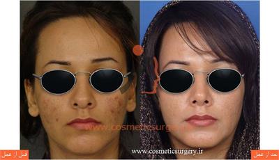 جراحی زیبایی بینی