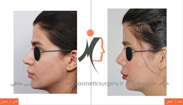 nouse cosmetic surgery 9
