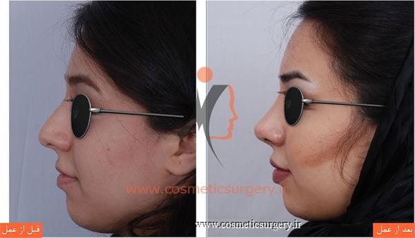 جراحی زیبایی بینی