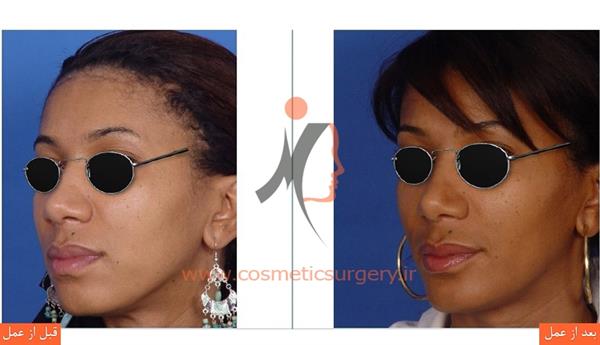 جراحی بینی گوشتی3