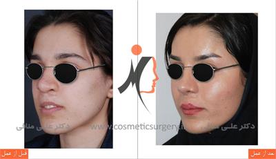 عمل ترمیم بینی شکاف لب E6