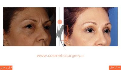لیفت پیشانی به همراه تزریق چربی 1
