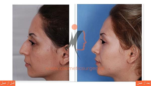 جلو آوردن چانه به همراه جراحی بینی و تزریق چربی