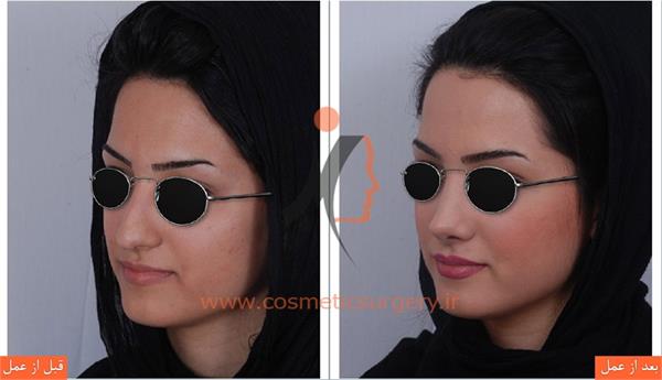 جراحی زیبایی بینی