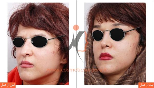 جراحی زیبایی بینی  1