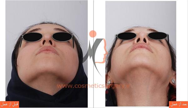 جراحی زیبایی بینی