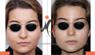 nouse cosmetic surgery 5