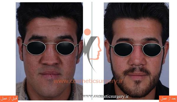 ترمیم بینی در بیماری که قبلا توسط جراحان دیگری عمل شده است