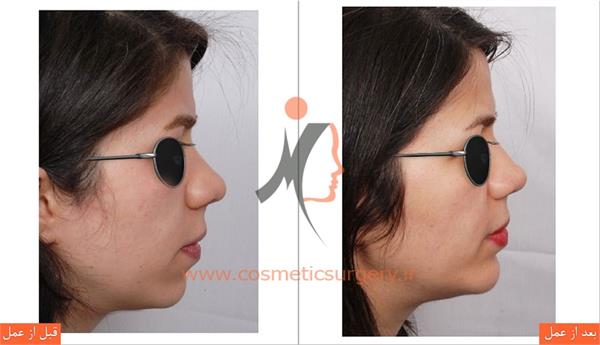 جراحی چانه 1