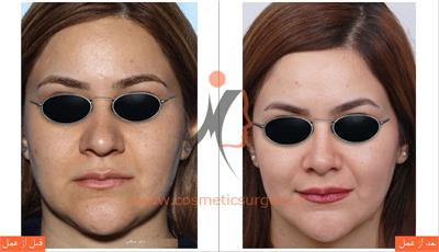 جراحی زیبایی بینی  1