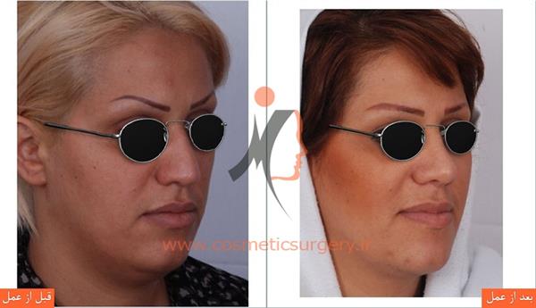 جراحی انحراف بینی