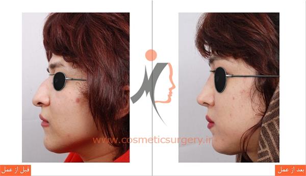 جراحی زیبایی بینی  2