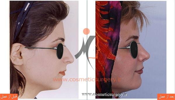 جراحی زیبایی بینی به همراه تزریق چربی