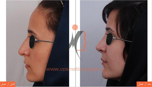 جراحی زیبایی بینی