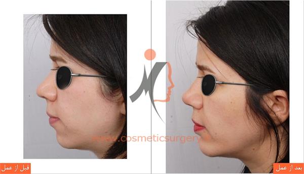 جراحی چانه 2