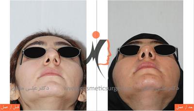 nouse cosmetic surgery