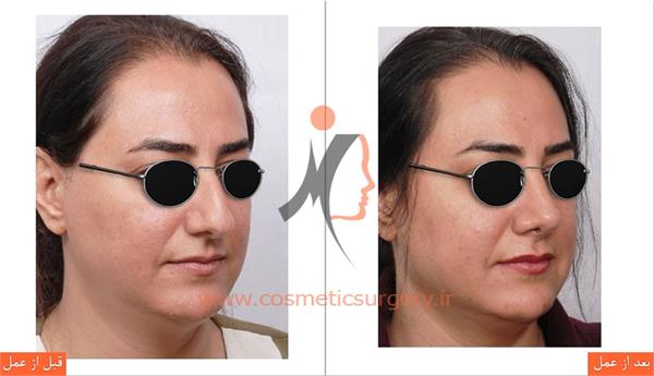 جراحی زیبایی بینی 1