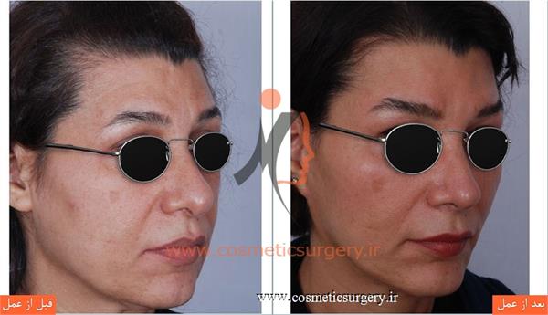 جراحی زیبایی بینی بهمراه لیفت صورت و تزریق چربی