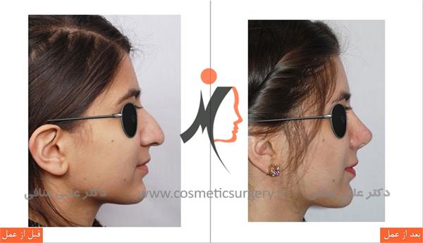 عمل جراحی انحراف بینی 3