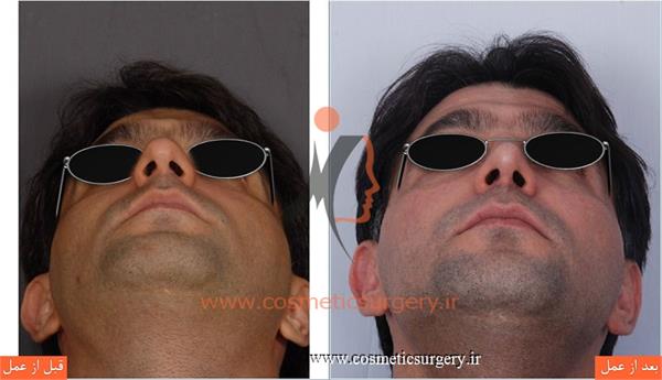 عمل جراحی انحراف بینی