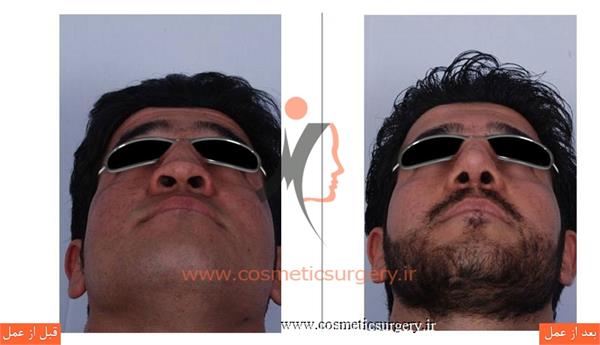 ترمیم بینی در بیماری که قبلا توسط جراحان دیگری عمل شده است