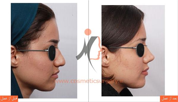 جراحی زیبایی بینی 3