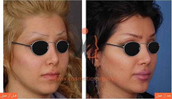 ترمیم بینی عمل شده توسط جراحان دیگر به همراه بلندتر کردن بینی و افزایش تناسب بینی