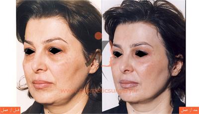 جراحی پلک به همراه جوان سازی دور پلک