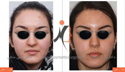 عمل جراحی زیبایی بینی گوشتی 2