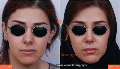 عمل جراحی انحراف بینی