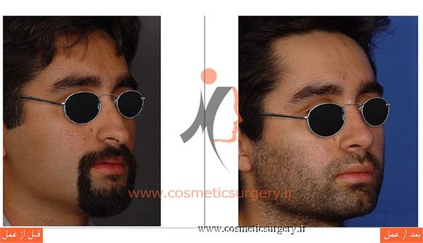 جراحی زیبایی بینی