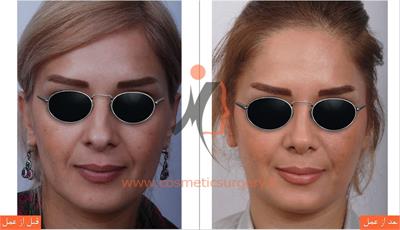 جراحی زیبایی بینی