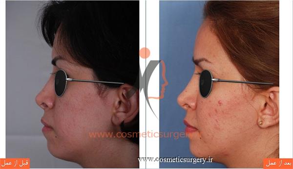 تزریق چربی صورت و گونه
