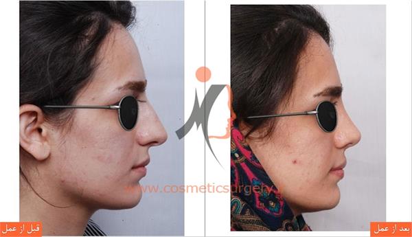 جراحی زیبایی بینی 3