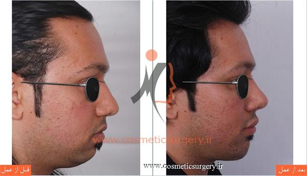 عمل جراحی بینی گوشتی