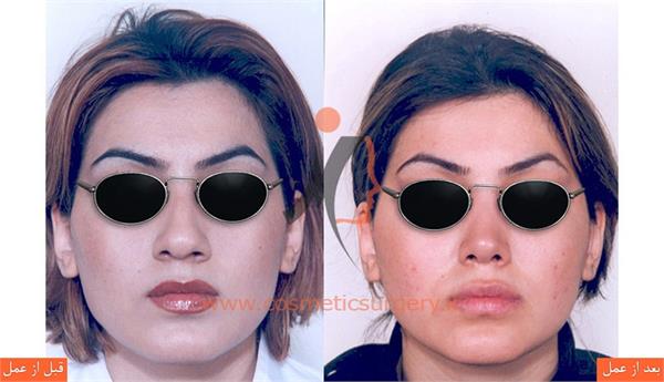 جراحی زیبایی بینی