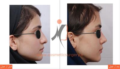 جراحی زیبایی بینی 1