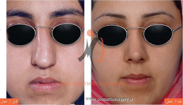 عمل جراحی انحراف بینی