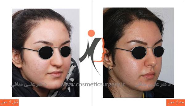 عمل جراحی زیبایی بینی گوشتی 3