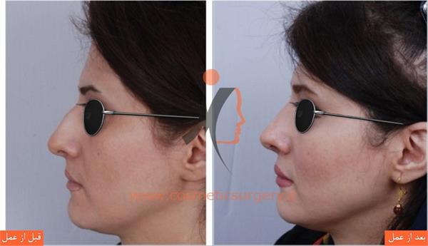 جراحی زیبایی بینی